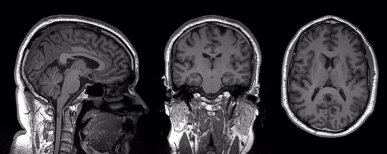 MRI scan of Remy's brain, his straight nose rather prominent!