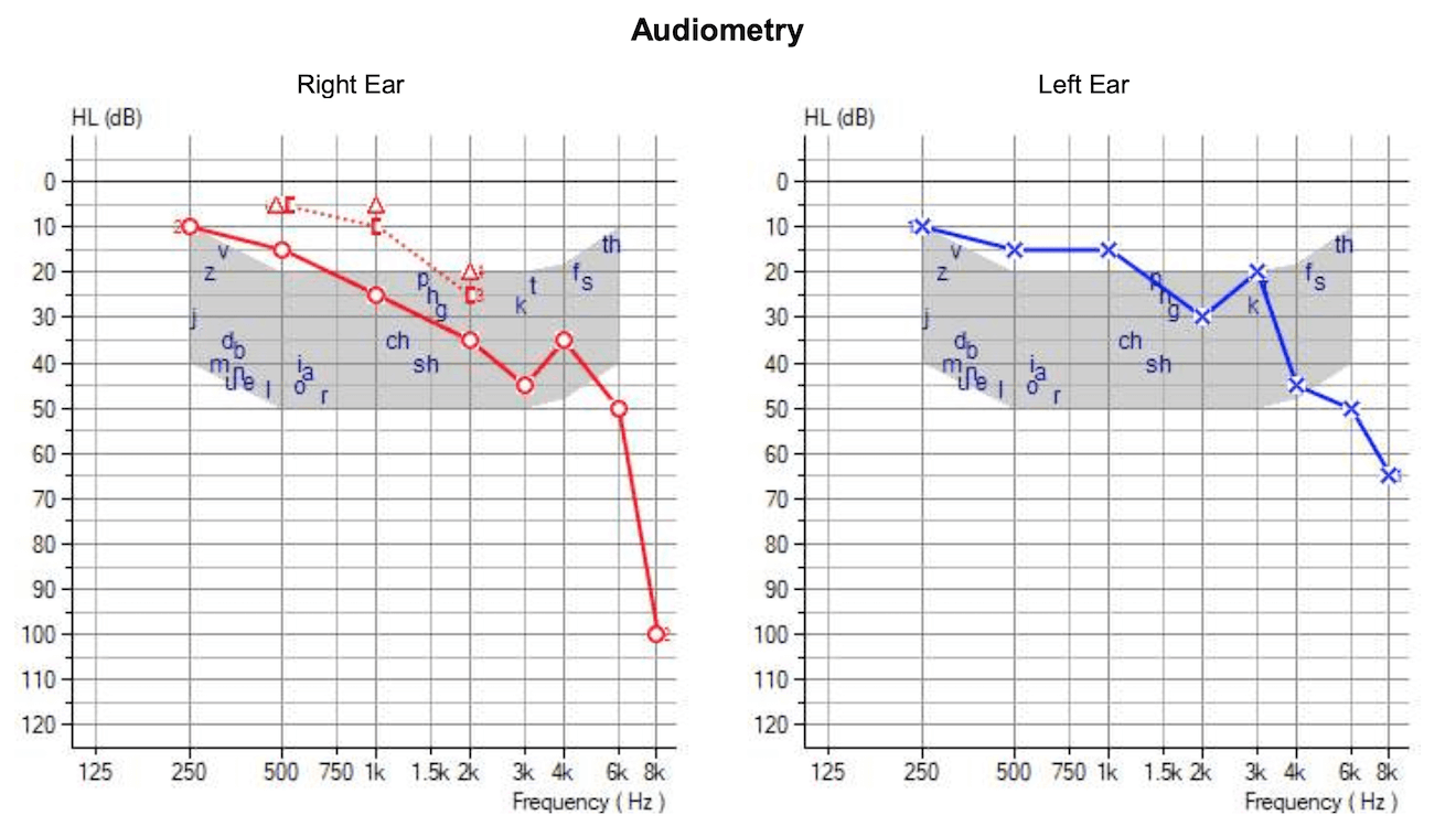 Two charts showing a range of hearing ability with a strong drop off at the right side on both charts, where "fs" and "th" sounds are heard